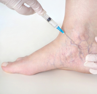 ESCLEROTERAPIA