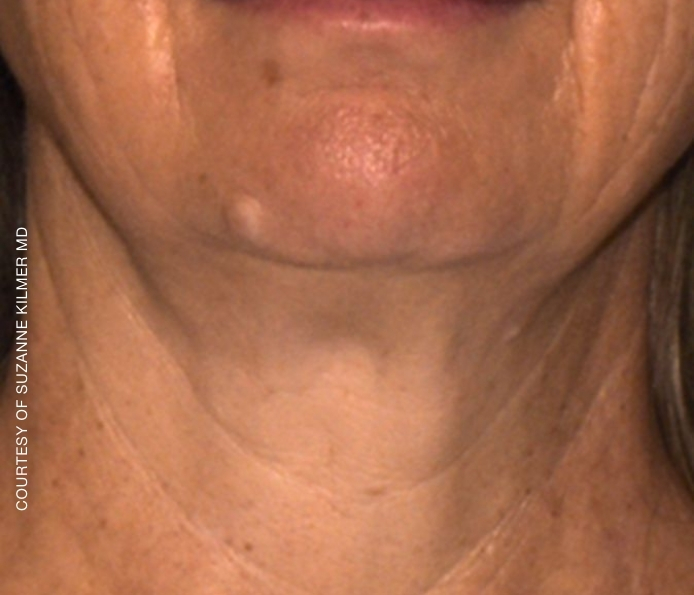 Neck-Suzanne-Kilmer-After