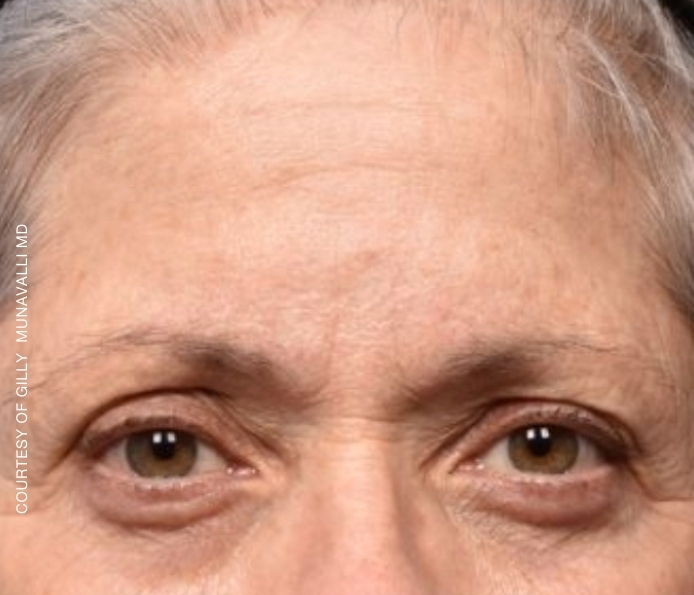 eyebrows-Dr-Munavalli-Before
