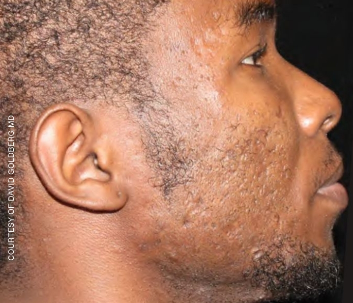 Acne-scars-Dr.-David-Goldberg-After