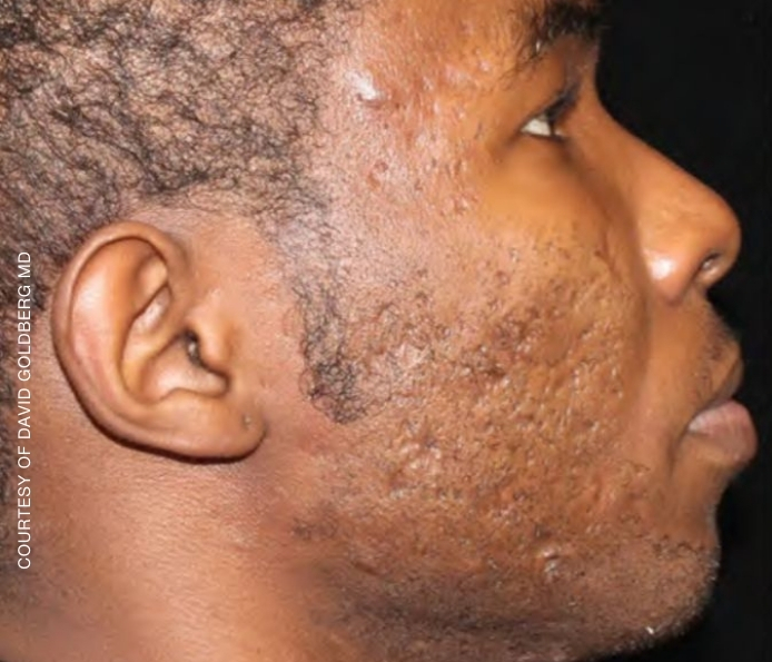 Acne-scars-Dr.-David-Goldberg-Before-1