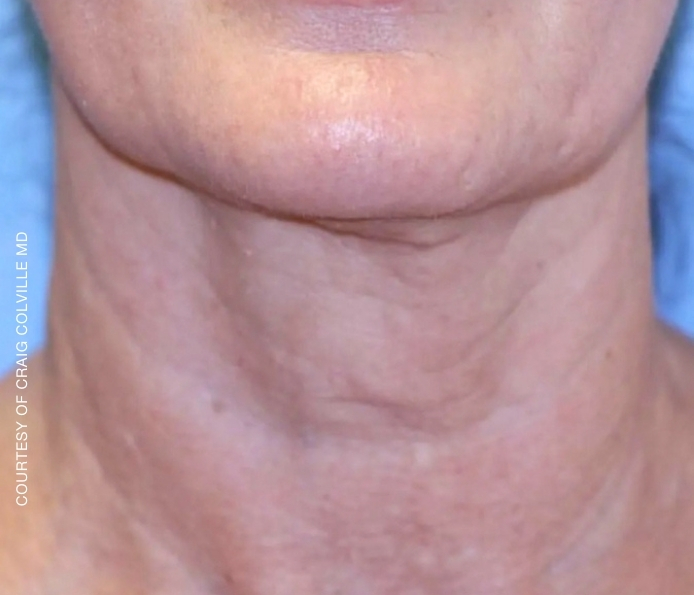 Neck-Craig-Colville-MD-after