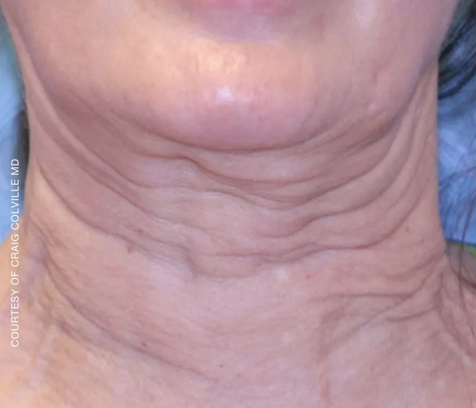 Neck-Craig-Colville-MD-before