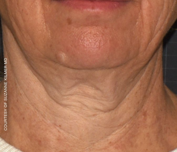 Neck-Suzanne-Kilmer-Before-1