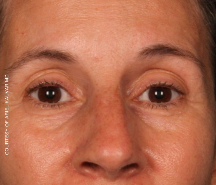 eyebrows-Dr-Kauvar-After