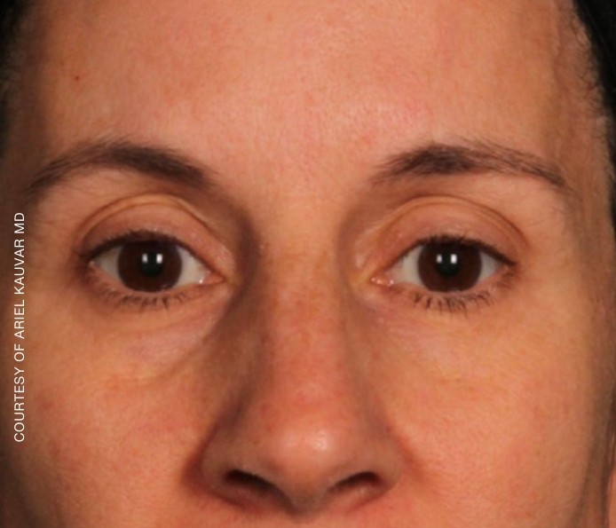 eyebrows-Dr-Kauvar-Before