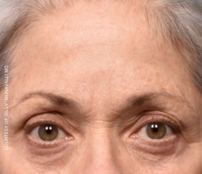 eyebrows-Dr-Munavalli-After