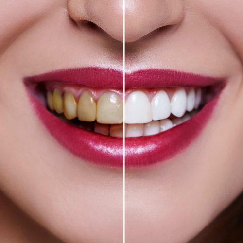 how-long-does-teeth-whitening-last-scaled
